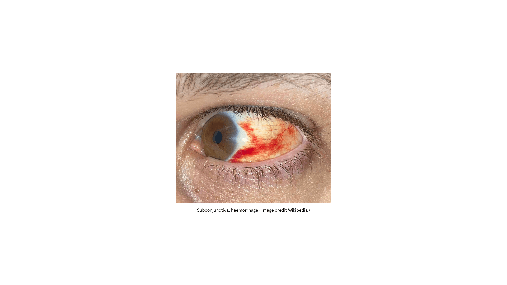 Subconjunctival hemorrhage