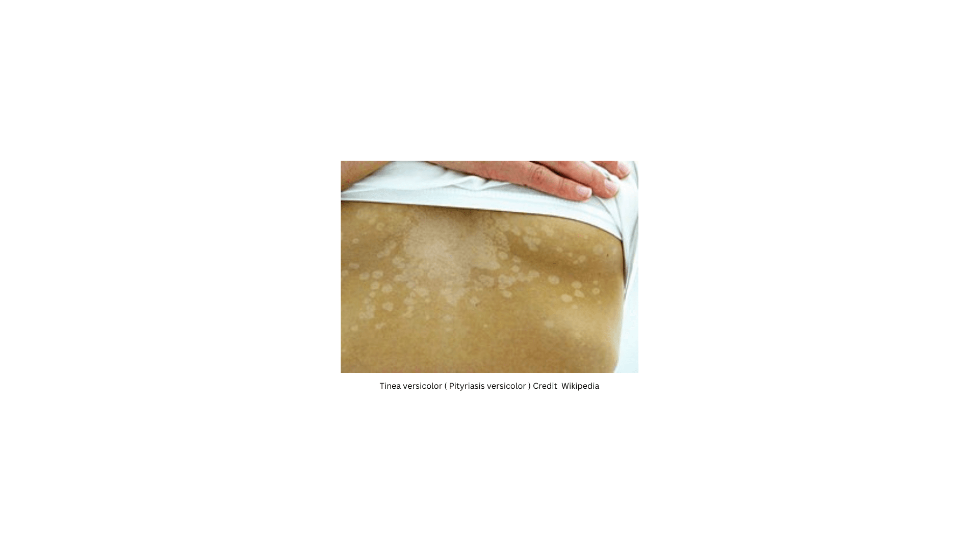 Pityriasis versicolor