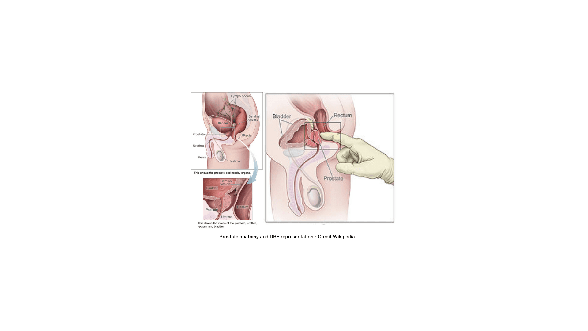 Prostate : examination and anatomy