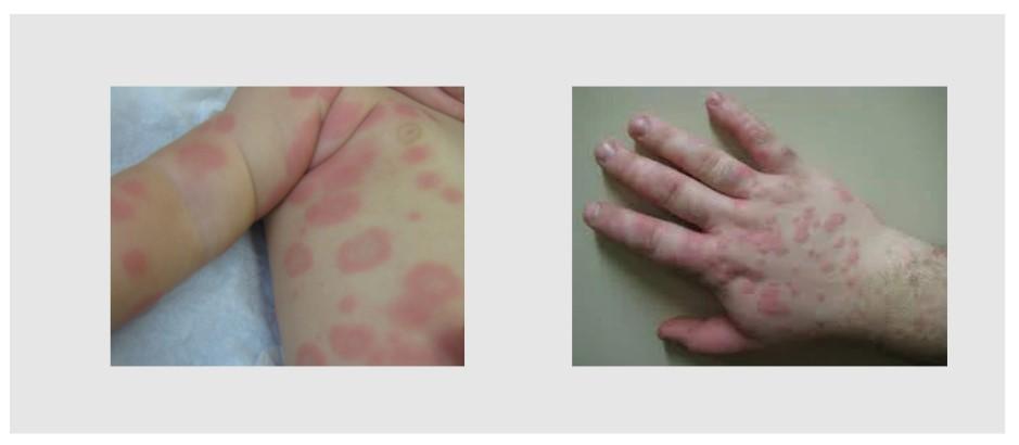 Erythema multiforme